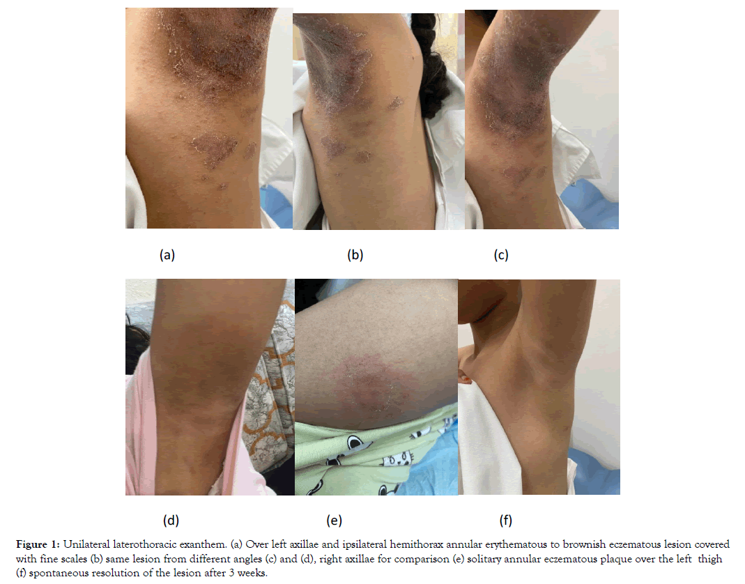 dermatology-ipsilateral-hemithorax