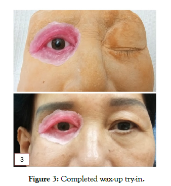 reconstructive-surgery-anaplastology-completed