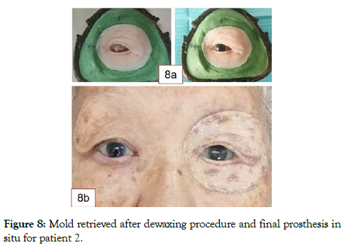 reconstructive-surgery-anaplastology-dewaxing