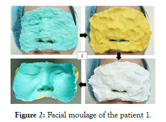 reconstructive-surgery-anaplastology-moulage