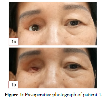 reconstructive-surgery-anaplastology-photograph