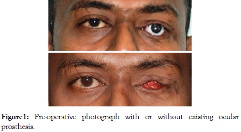 reconstructive-surgery-anaplastology-prosthesis