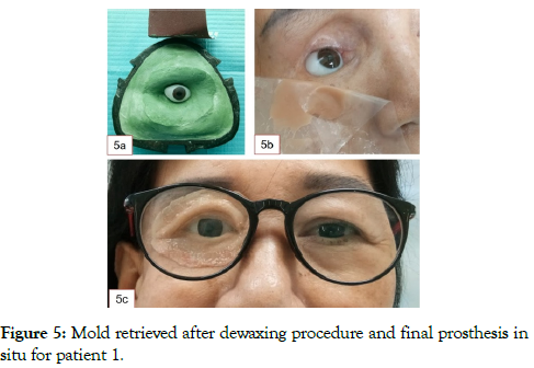 reconstructive-surgery-anaplastology-retrieved