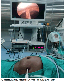 surgery-current-Umbilical