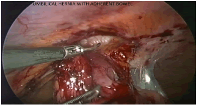 surgery-current-bowel