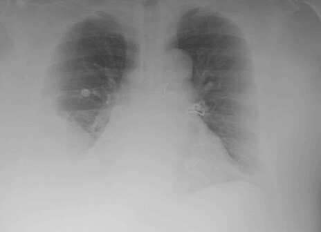 surgery-current-costophrenic-cephalad