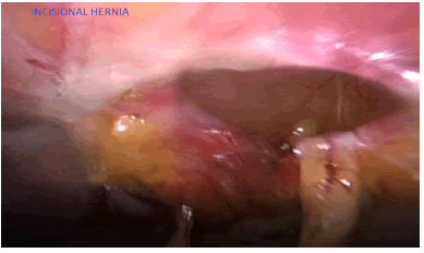 surgery-current-hernia