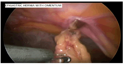 surgery-current-omentum