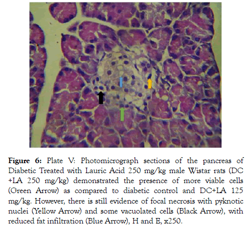 diabetes-metabolism-infiltration