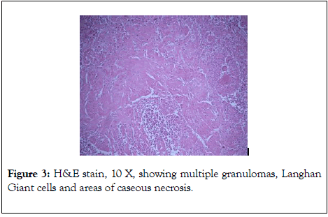 forensic-pathology-caseous-necrosis