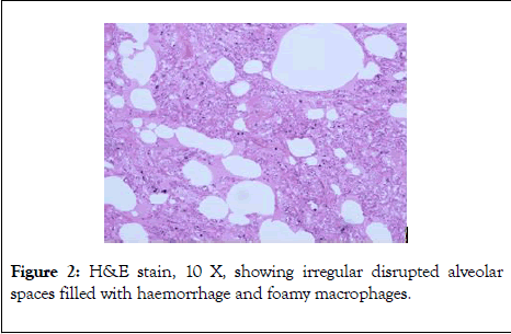 forensic-pathology-foamy-macrophages