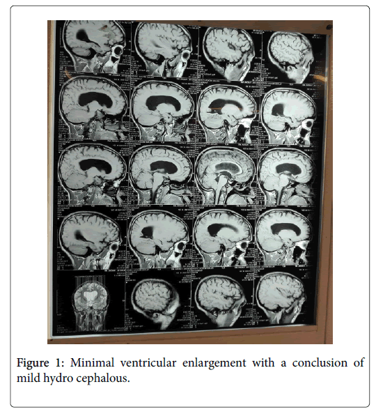 general-medicine-ventricular-enlargement