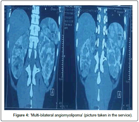 kidney-Multi-bilateral