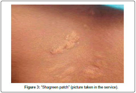 kidney-Shagreen-patch