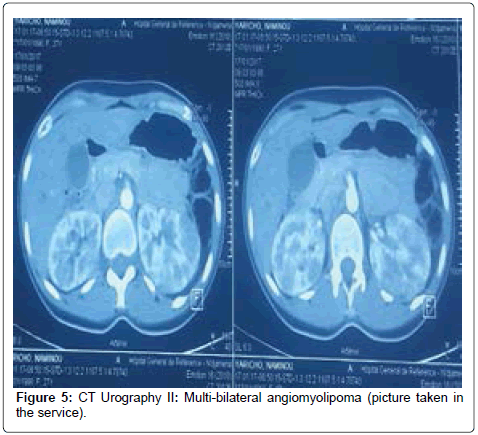 kidney-Urography