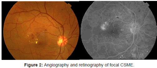 diabetes-metabolism-Angiography-retinography